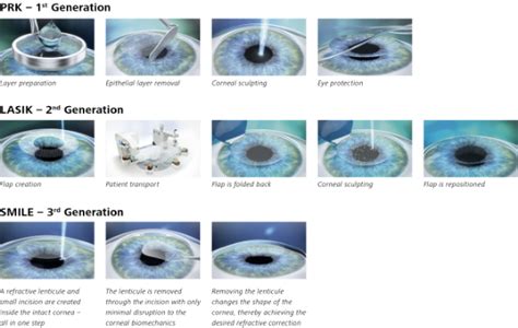 Differences And Benefits Of Laser Vision Correction Techniques Differences And Benefits Of Laser Vision Correction Techniques